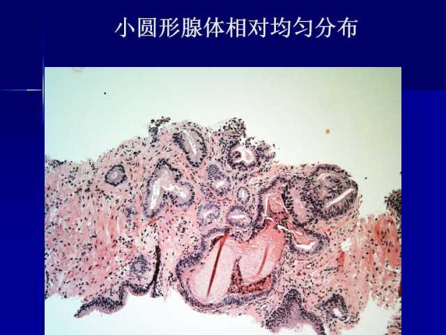 前列腺病理诊断线索（上）——黄教悌
