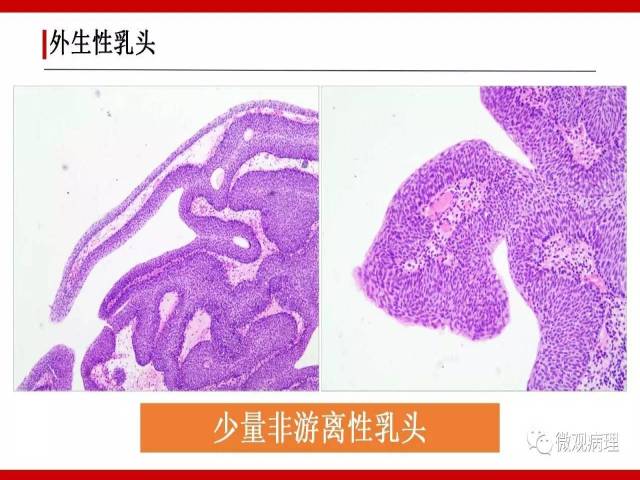 泌尿课程/非浸润性尿路上皮病变诊断的一些困惑