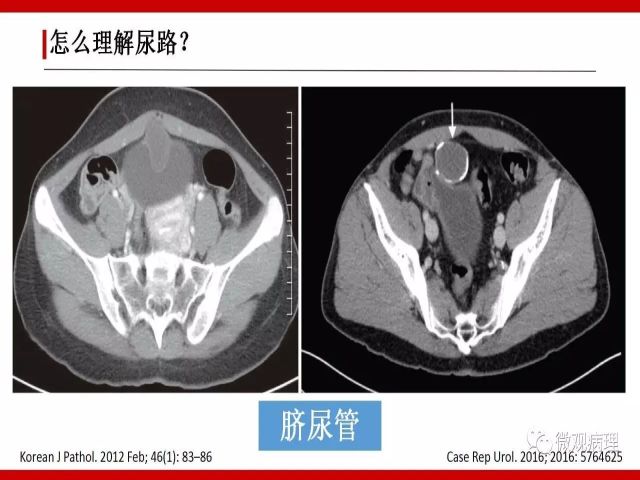 泌尿课程/尿路腺样病变的诊断要点