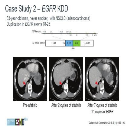Genomic profiling of 114,200 advanced cancers identifies recurrent kinase domain duplications (KDD)