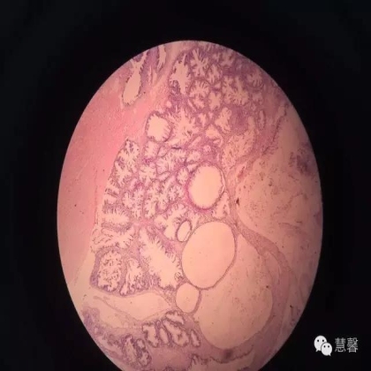 交界性黏液性囊腺瘤？癌？（魏娉分享，刘从容老师讲解）
