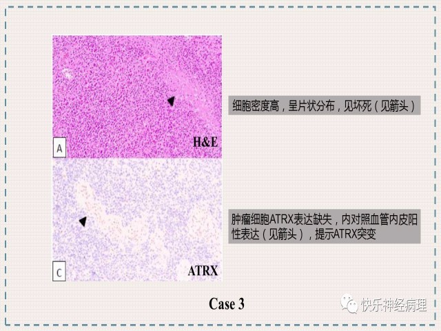 胶质瘤分子结果矛盾时如何整合诊断