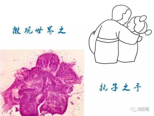 另类甲状腺FNA细胞学