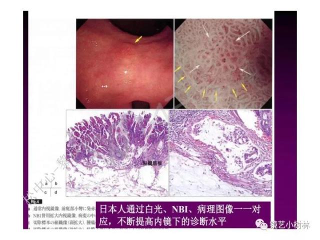 上消化道早癌病理的学习心得体会（附胃牵手癌的病例特点文献学习）