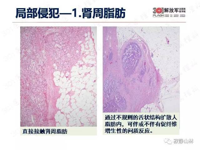 泌尿系统常见肿瘤标本病理报告规范