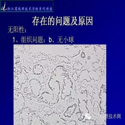探讨免疫组织学在肾穿标本中的应用