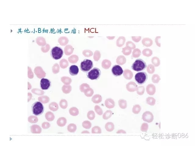 慢性淋巴细胞性白血病