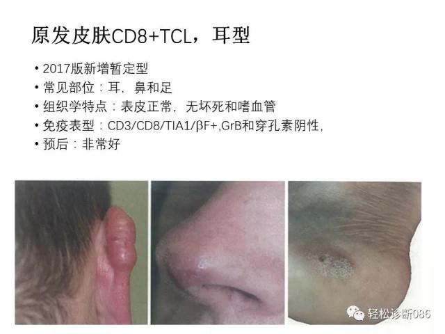 皮肤T细胞淋巴瘤