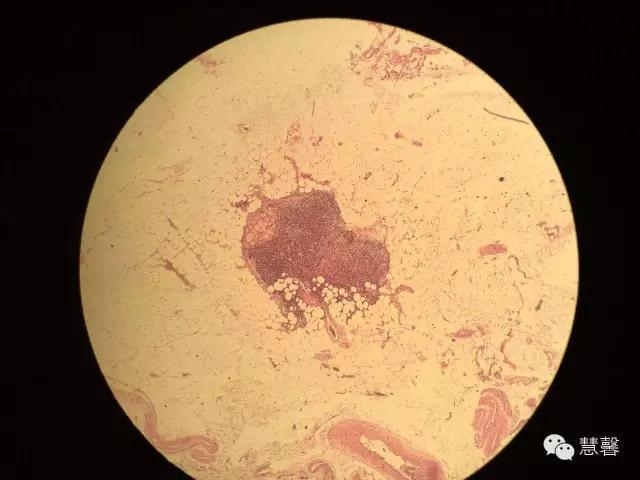 甲状腺乳头状癌伴喉返神经旁淋巴结中见小块分化好的甲状腺组织，转移癌？（阿姚分享，孔祥田(Max)*Roswell*NM老师讲解）