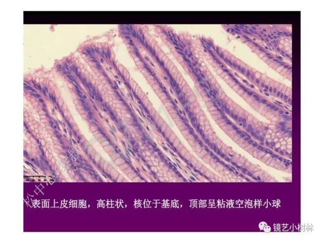上消化道早癌病理的学习心得体会（附胃牵手癌的病例特点文献学习）