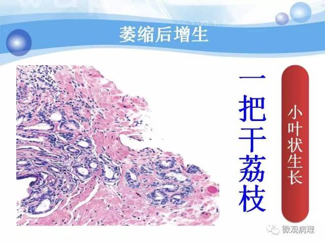 泌尿课程/局灶性前列腺萎缩