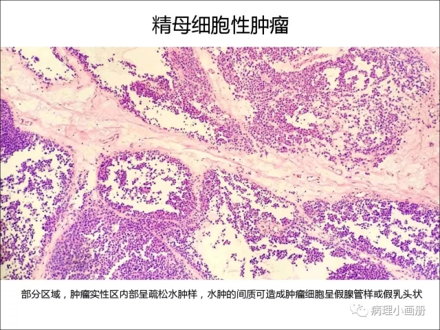 泌尿病理--精原细胞瘤VS精母细胞瘤