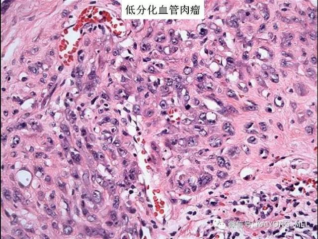 乳腺梭形细胞病变的病理诊断及进展（二）