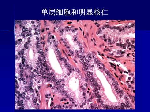 前列腺病理诊断线索（上）——黄教悌
