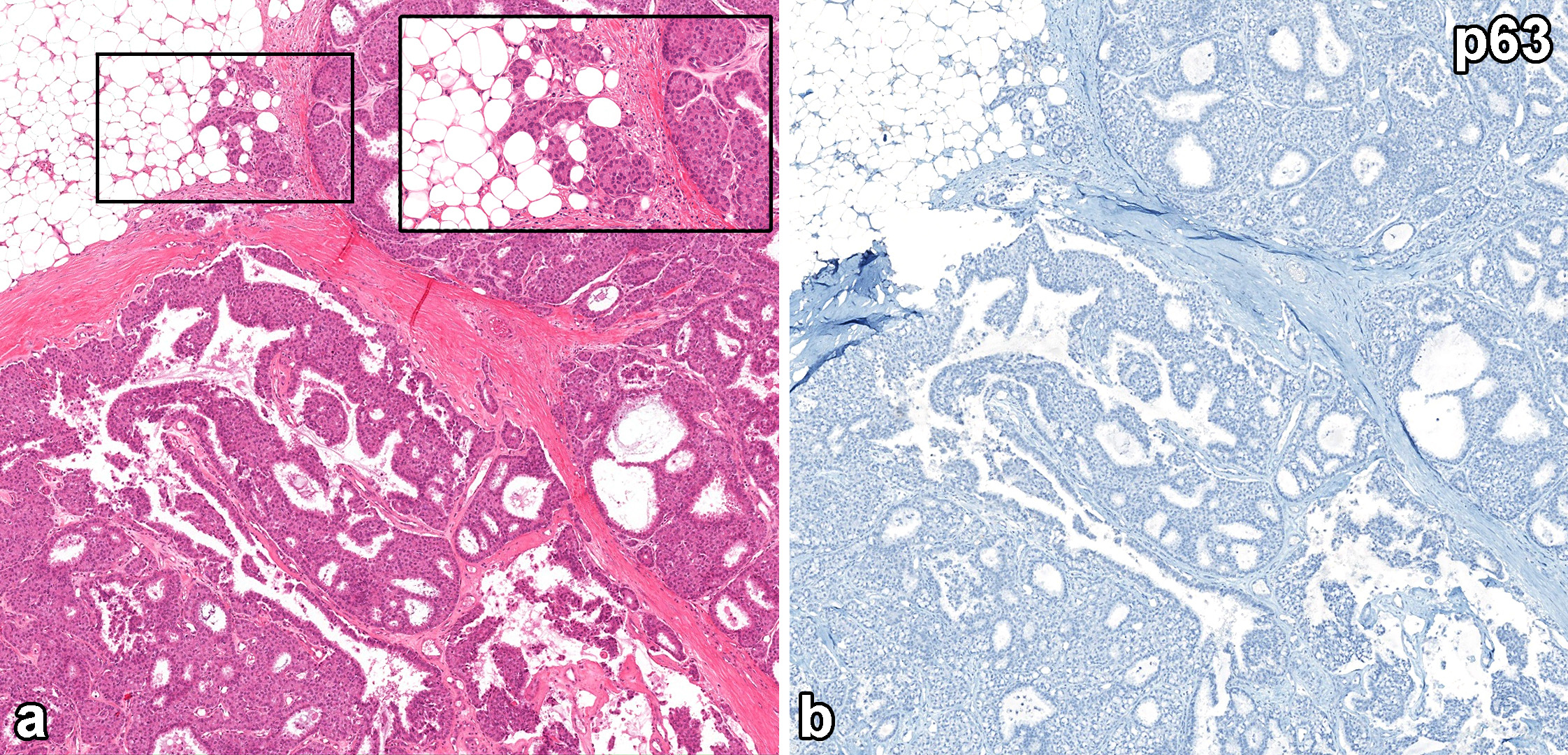 读文献，学病理-乳腺乳头状肿瘤难点总结（二）