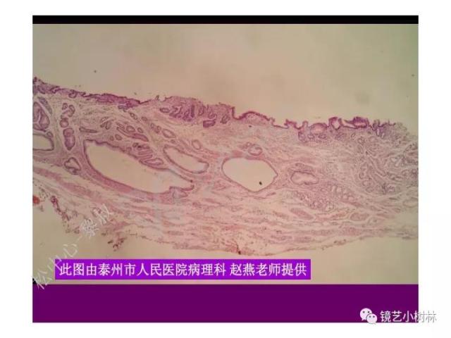 上消化道早癌病理的学习心得体会（附胃牵手癌的病例特点文献学习）