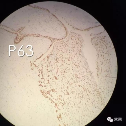 High grade nested variant Urothelial carcinoma(老胡分享，孔祥田老师讲解)