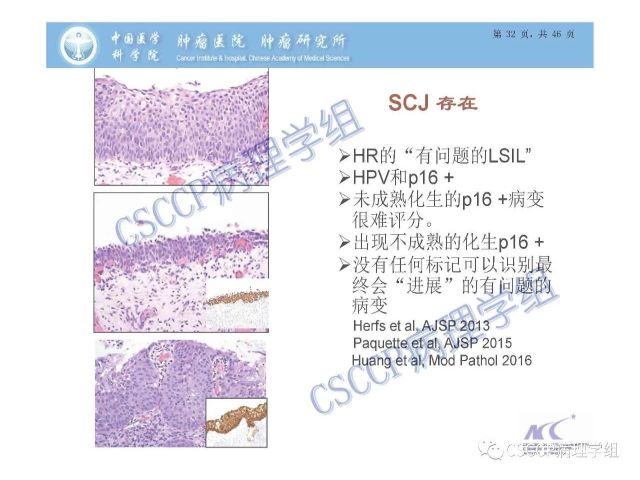 宫颈癌前病变中的诊断难点及阴道镜中ECC的 应用价值