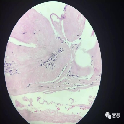 乳腺叶状肿瘤诊断（慧馨分享，孔祥田(Max)*Roswell*NM老师讲解）