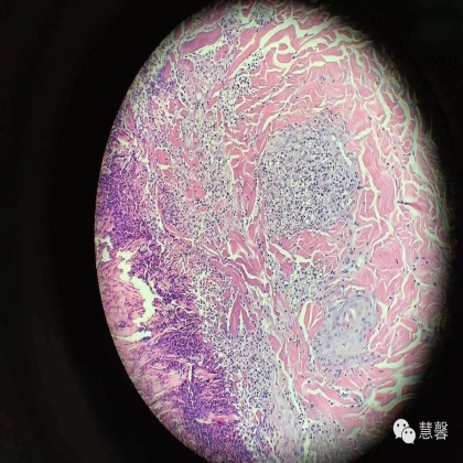 Acquired perforating dermatosis（孔祥田(Max)*Roswell*NM]分享及讲解）