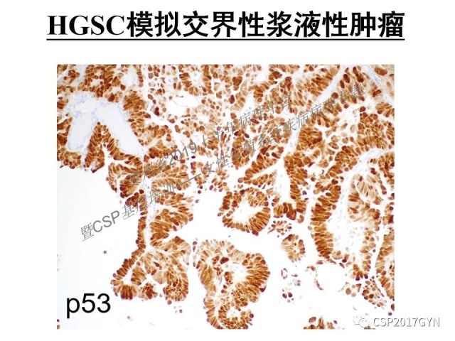 中华病理学会基层培训遵义站讲座（一）——卵巢和输卵管浆液性肿瘤的诊断和鉴别诊断