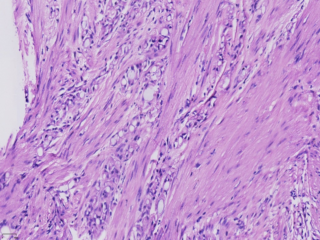 子宫腺瘤样瘤