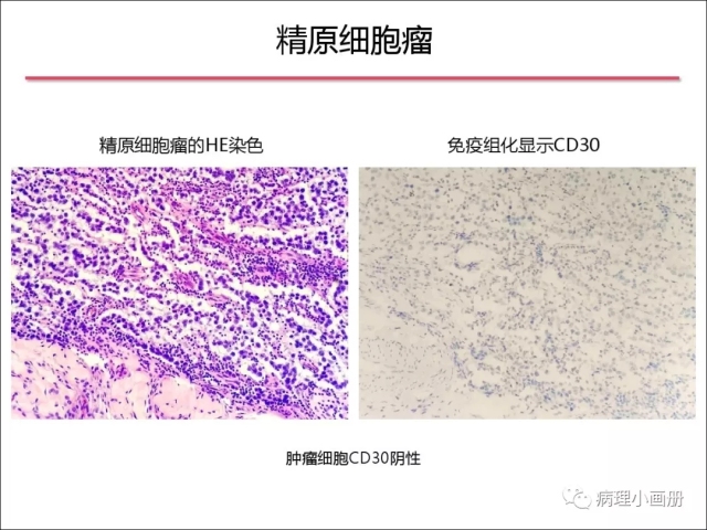 泌尿病理--精原细胞瘤VS精母细胞瘤