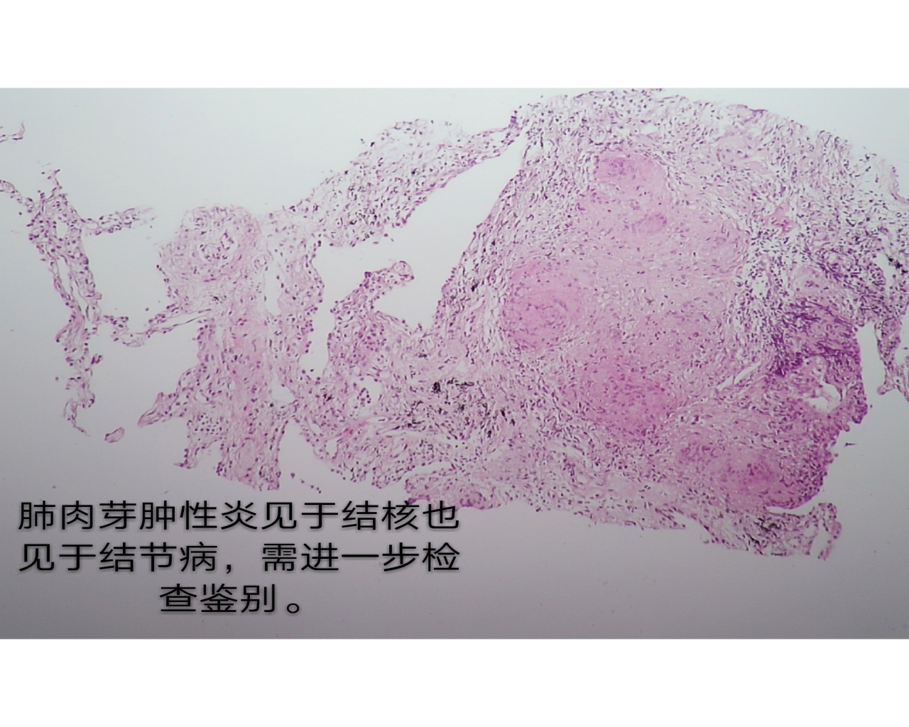 一张病理报告就一定能一锤定音吗？
