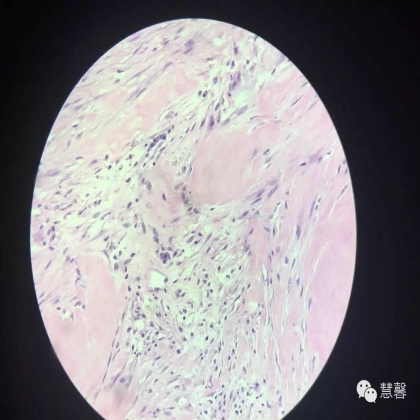 乳腺叶状肿瘤诊断（慧馨分享，孔祥田(Max)*Roswell*NM老师讲解）