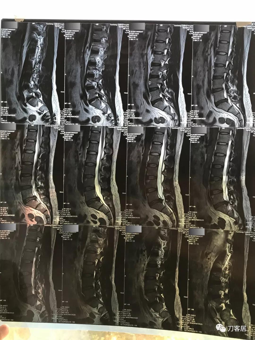 医生及患者通用:如何用手机翻拍X线片,磁共振片子,CT片子进行网络求医、病例讨论及保留资料 医生及患者通用:如何用手机翻拍X线片,磁共振片子,CT片子进行网络求医、病例讨论及保留资料