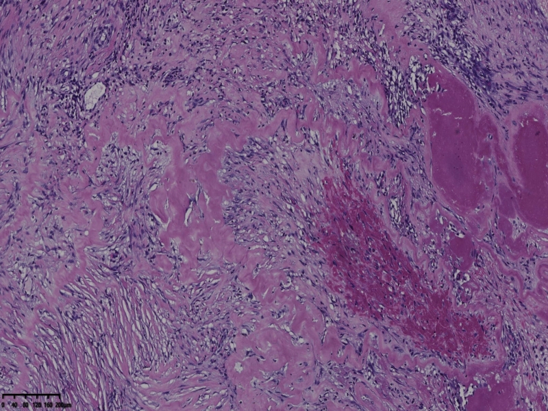 睾丸鞘膜肿物伴鞘膜积液