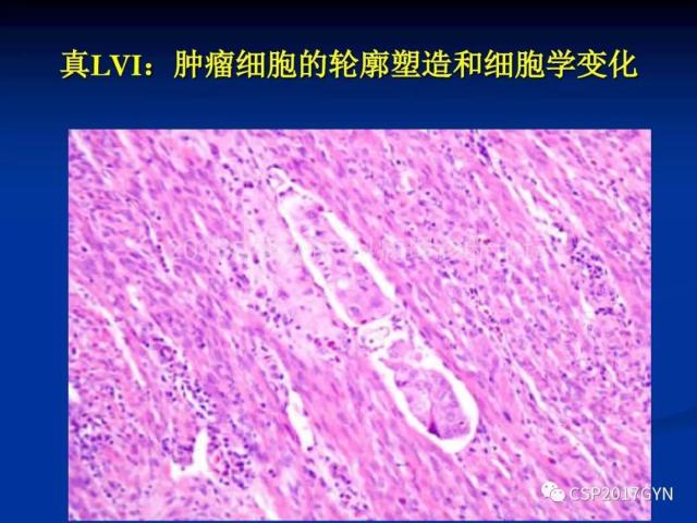 子宫内膜癌：诊断与进展