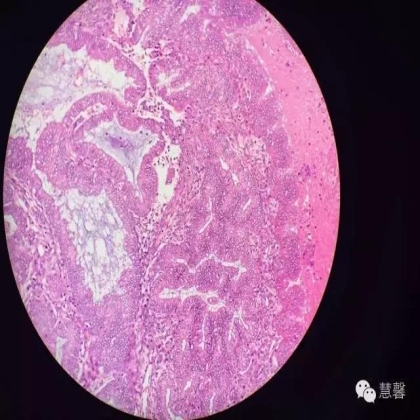 高分化子宫内膜样癌与分泌期子宫内膜、黏液腺癌的鉴别（孔令英分享，刘从容老师讲解）