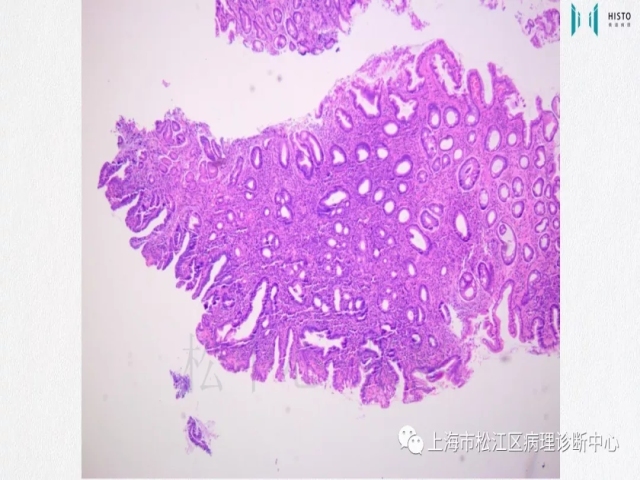 上消化道早癌病理诊断中的困惑及基本对策回顾