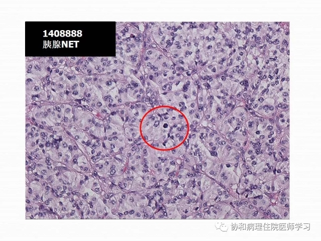 病理学基础知识 : 核分裂像的识别