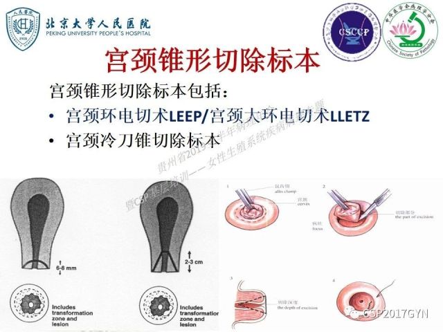 中华病理学会基层培训遵义站讲座（三）——宫颈鳞状上皮病变的病理诊断与鉴别诊断