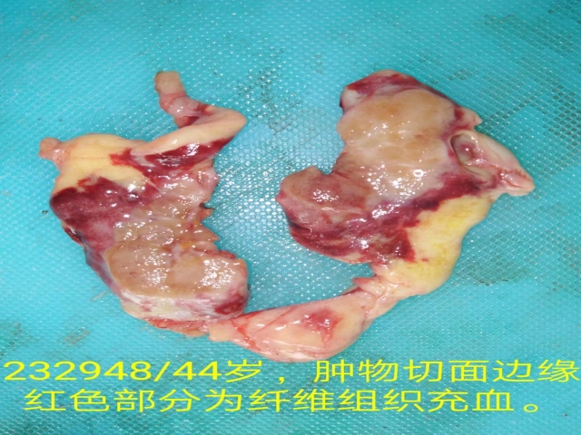 术中冰冻诊断有分歧的乳腺浸润性癌（九十）