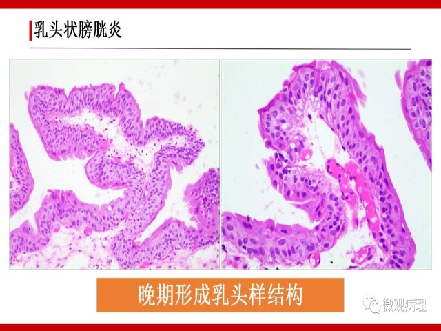 泌尿课程/非浸润性尿路上皮病变诊断的一些困惑
