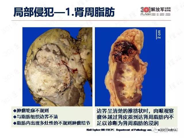 泌尿系统常见肿瘤标本病理报告规范