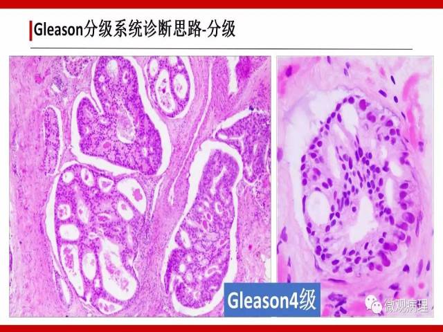 前列腺癌Gleason分级系统的前世今生