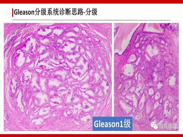 前列腺癌Gleason分级系统的前世今生