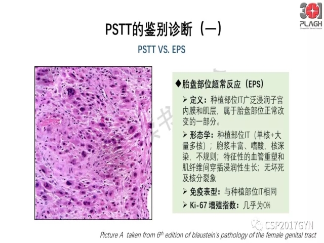 中间型滋养细胞肿瘤的诊断及鉴别诊断