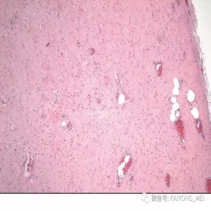 女性生殖道软组织肿瘤病理诊断及进展（二）