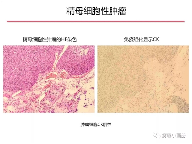 泌尿病理--精原细胞瘤VS精母细胞瘤
