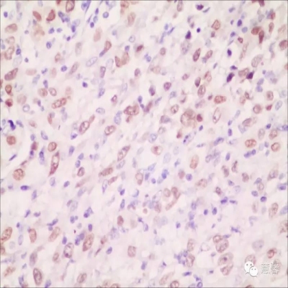 甲状腺癌乳头状癌伴未分化癌（肉瘤样癌）分化