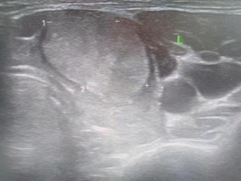 甲状腺滤泡癌19岁（101）