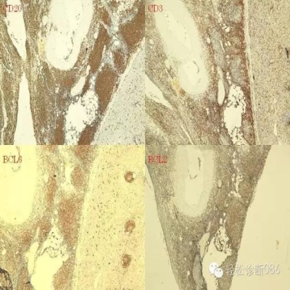 滤泡性淋巴瘤