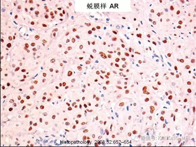 乳腺梭形细胞病变的病理诊断及进展（一）