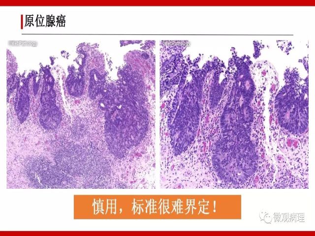 泌尿课程/尿路腺样病变的诊断要点