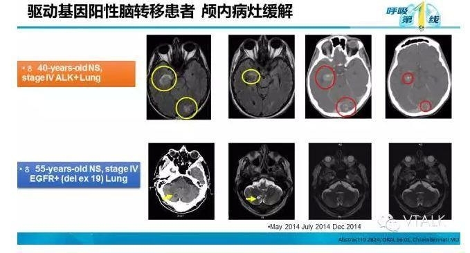 驱动基因阳性NSCLC脑转移：阿克琉斯之踵？